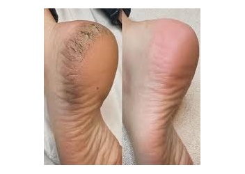 60MN CALLUS PEELING ( Spécial Callosités ) 